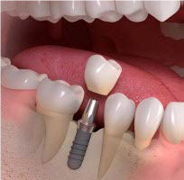 Dental implant treatment for missing teeth restoration.