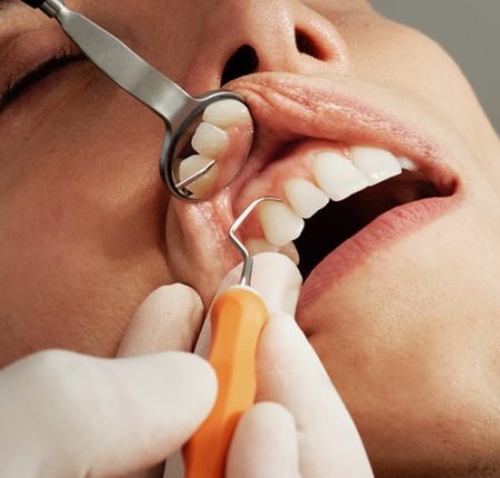 LANAP lasePeriodontal laser treatment for inflamed gums performed by Dr. Safar.r therapy for gum disease treatment at Dr. Safar’s clinic. Periodontal laser treatment for inflamed gums performed by Dr. Safar.